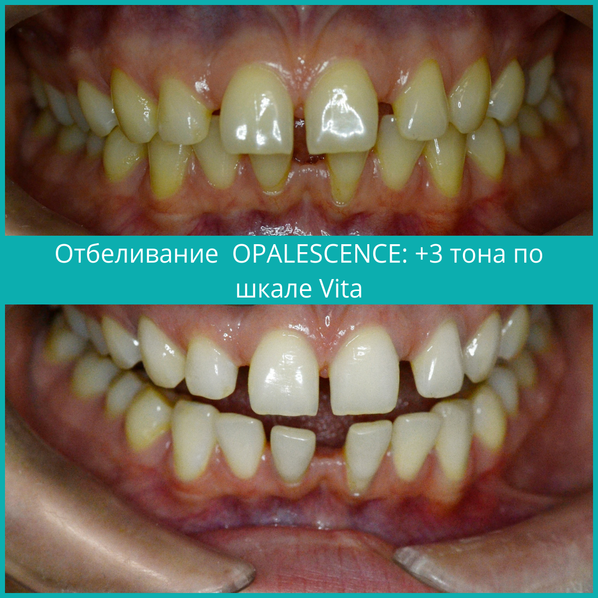 Отбеливание зубов Opalescence Томск Левобережный